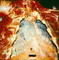 pulmones afectados