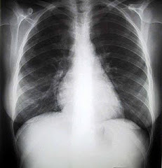 Una Radiografia de torax