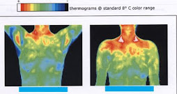 Permanent thermoregulatory dysfunction after ETS