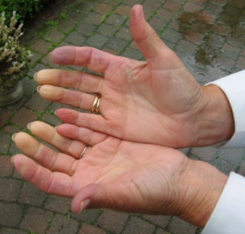 Denervation supersensitivity leads to Raynaud\