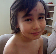 child chickenpox