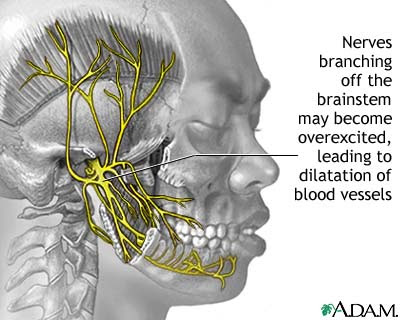 Faulty gene causes migraine