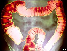 [_45123847_intestine_cred226.jpg]