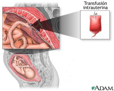 esquema de transfusión sanguñinea intrauterina