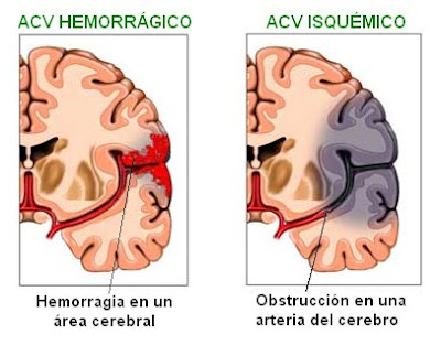 diferencias entre un accidente cerebrovascular hemorrágico y uno isquémico