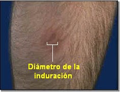 Reacción de Mantoux positiva