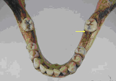 Gonfosis