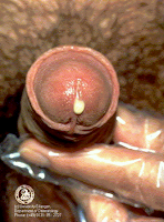Secreción purulenta por la uretra