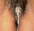 Secreción de pus por la vagina
