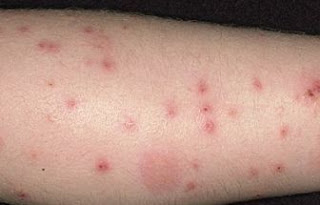 Lesiones por mordeduras de pulgas