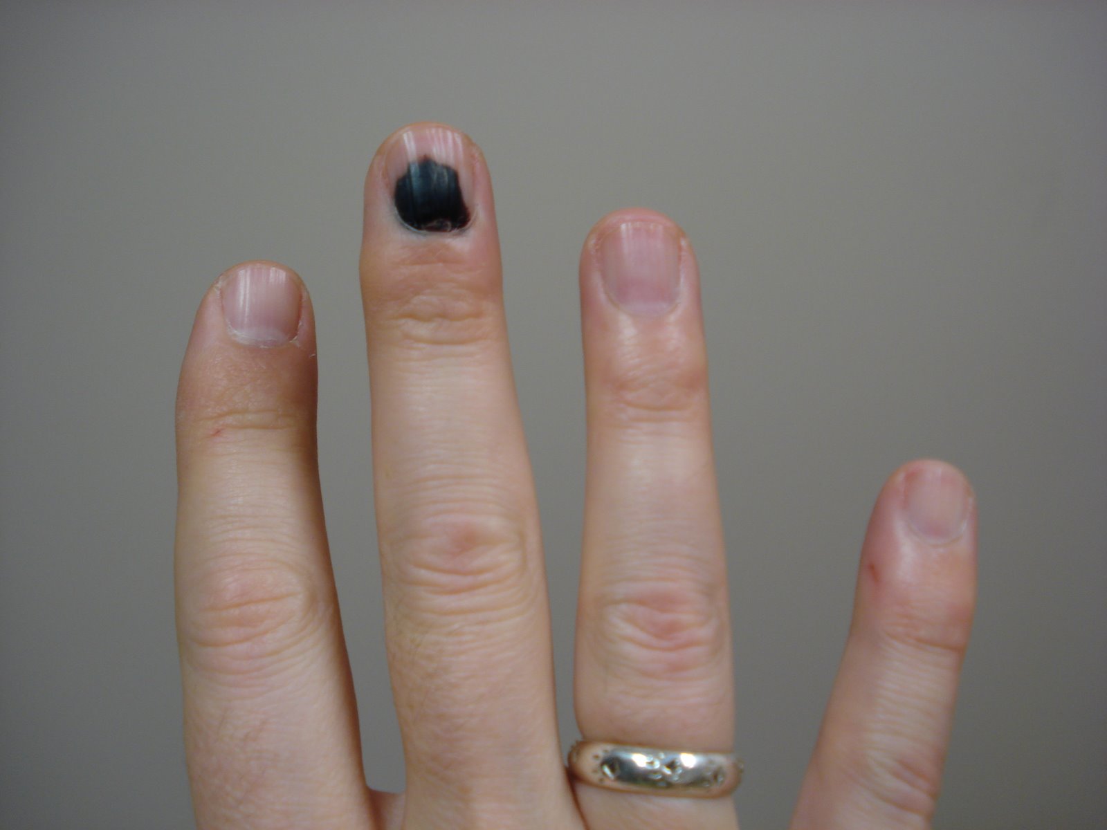 [bruise20080214.JPG]