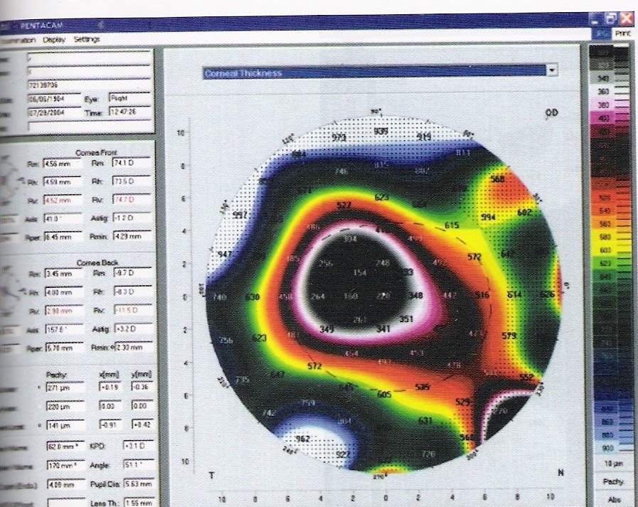 Pachymetry Assisted Laser Keratoplasty (PALK) a new approach to an old