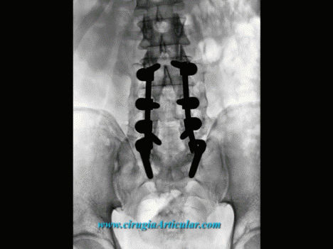 ESTENOSIS LUMBAR estenosis lumbar:
