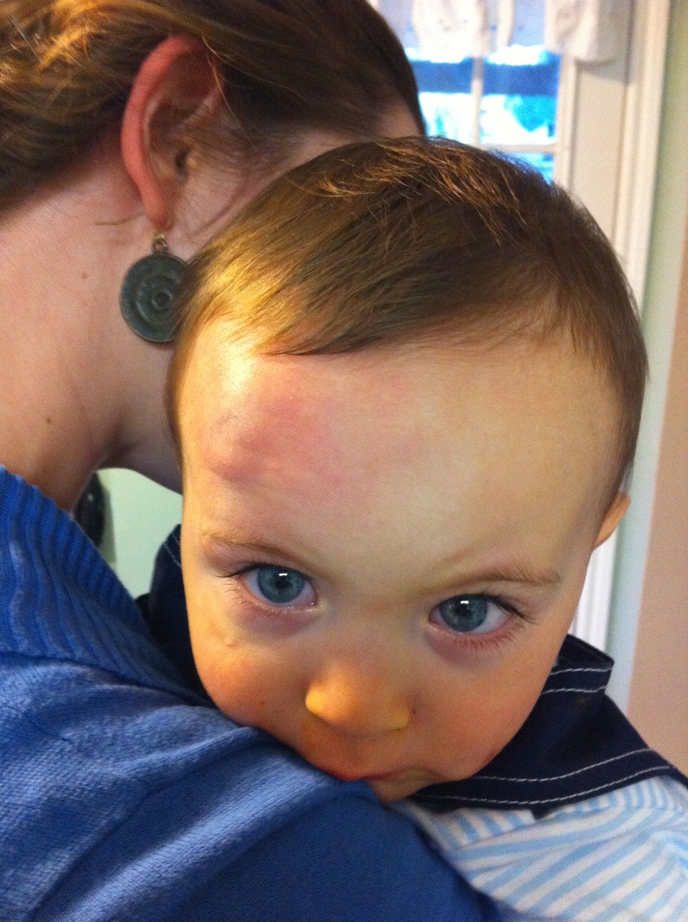 Bump on the head Erin Franco