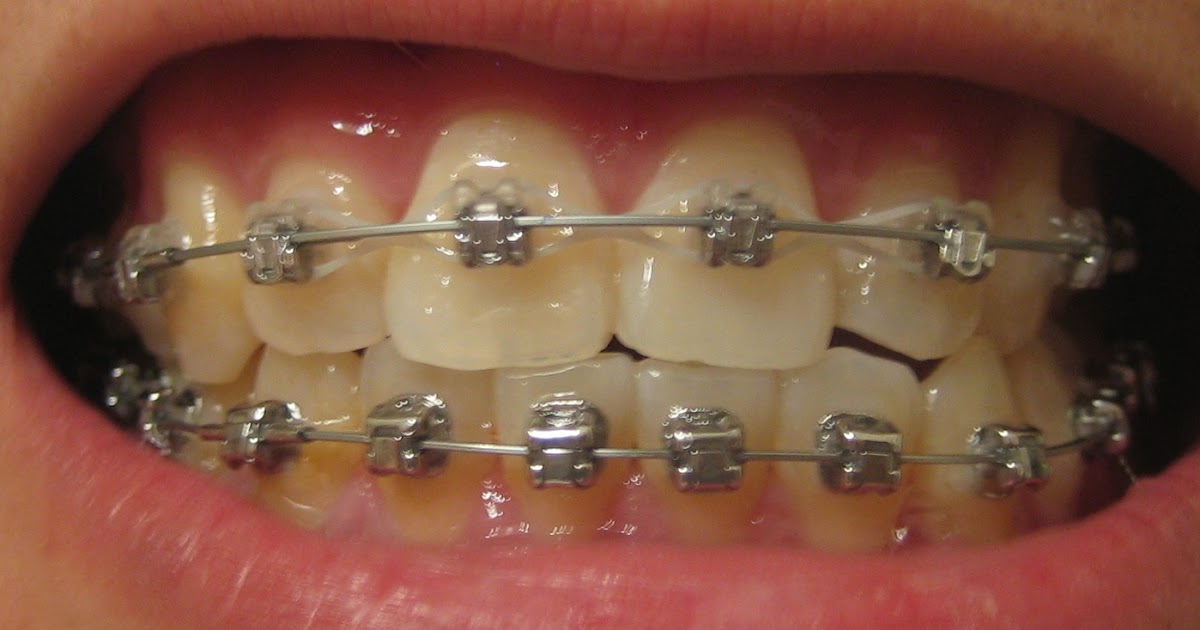 My Journey with the Damon Braces Week 33 Ortho Follow up & New wires