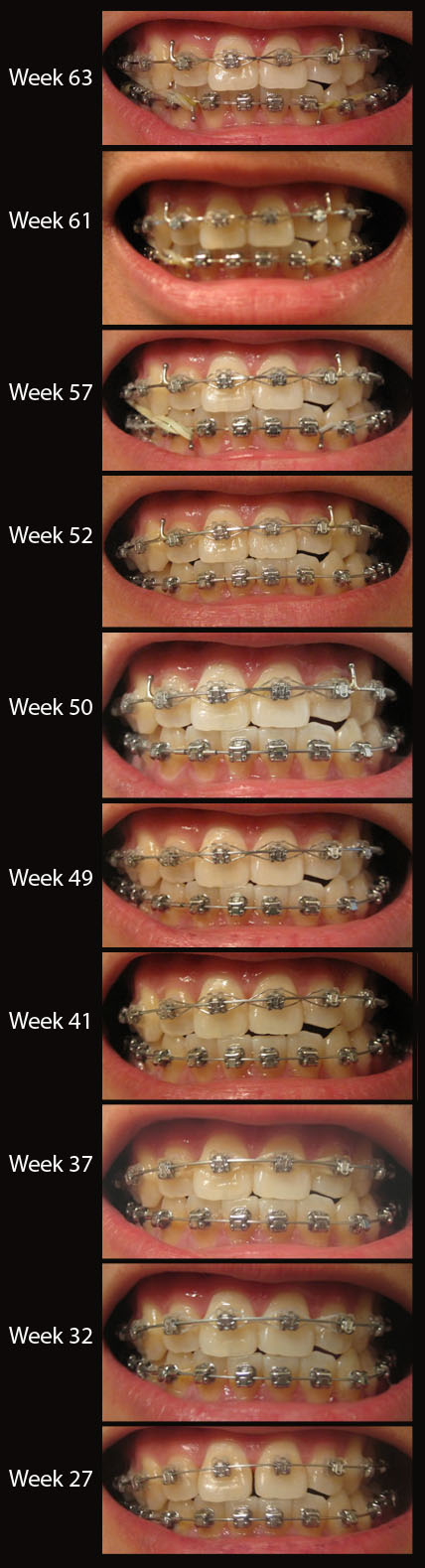 Braces Progress Photos