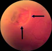 [retinaltear.jpg]