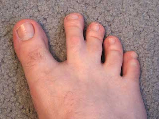 Human Webbed Toes