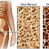 Osteoporose e Fisioterapia