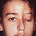 Fotos de pessoas com paralisia facial
