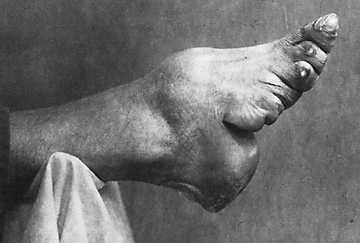 [womans_foot.jpg]