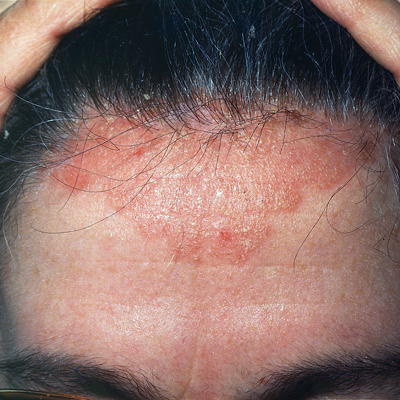 Psoriasis Of The Scalp. Prevent scalp from becoming