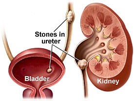 stages kidney stones stages kidney stones