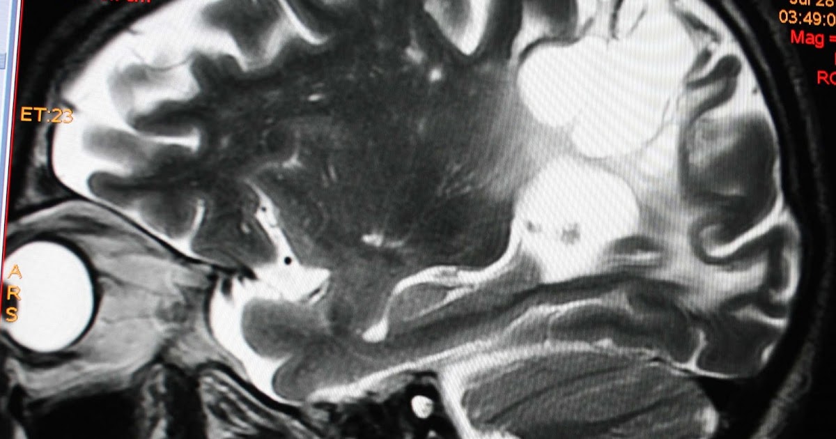 METROSCANS Cortical basal ganglionic degeneration