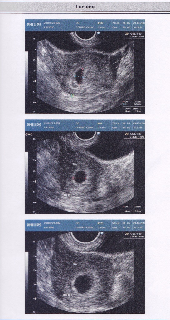 Nosso Bebê a Bordo: Gestação de 6 semanas