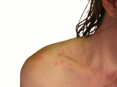 Canadian Bed Bugs
