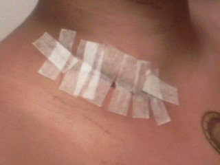 Biopsy Sugery