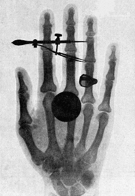 Anna Bertha's hand by Willhem Conrad Roentgen