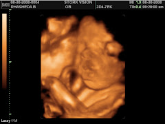 3D Ultrasound