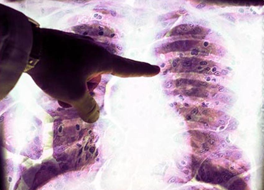 Procuration of Mesothelioma Procuration of Mesothelioma