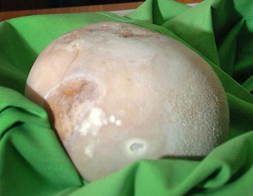 [9+calculo+renal.jpg]