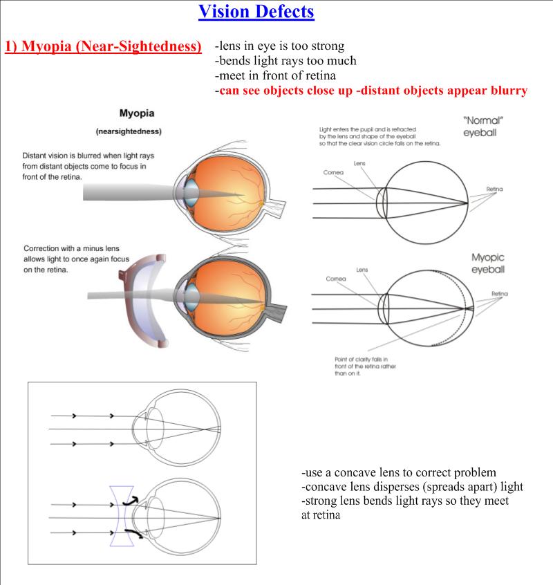 Vision Defects Defects Of Vision. Vision Defects