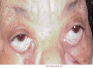 Conjunctival Pallor