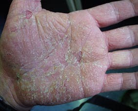 El frío influye sobre la psoriasis