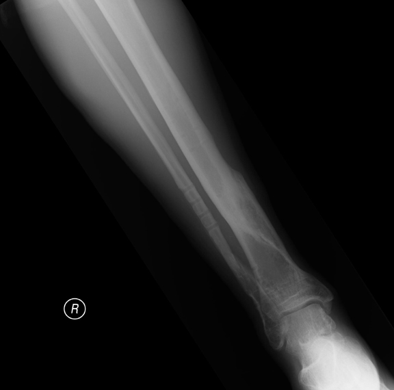 Snapped Fibula