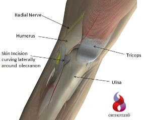 Tricep Tendon