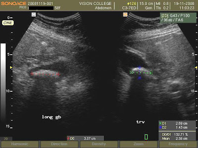 Ultrasound showed a large gallbladder stones ultrasound. Ultrasound showed a large