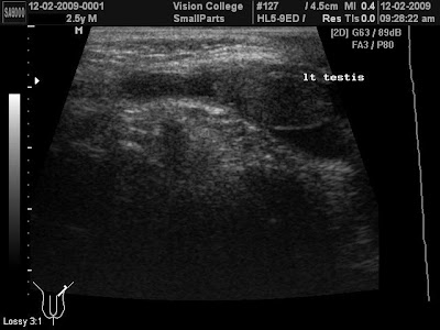 Non communicating hydrocele in adults