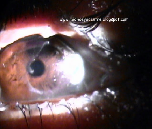 A Case Of Chemical Burns of the eye. Take Care Of Your Eyes