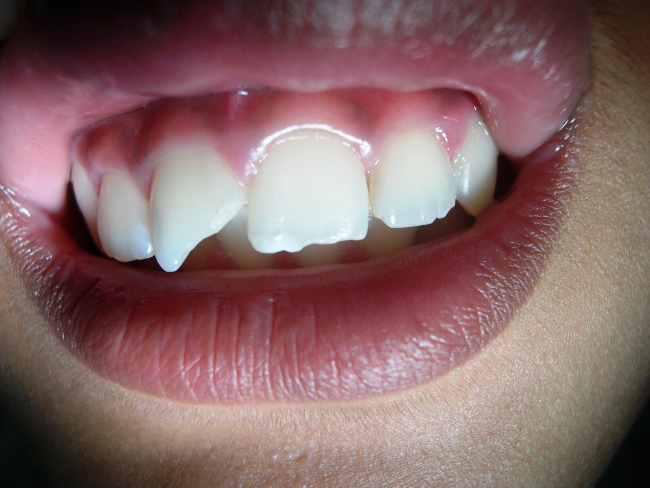 true smile dental clinic Restoration of Fractured Anterior Teeth