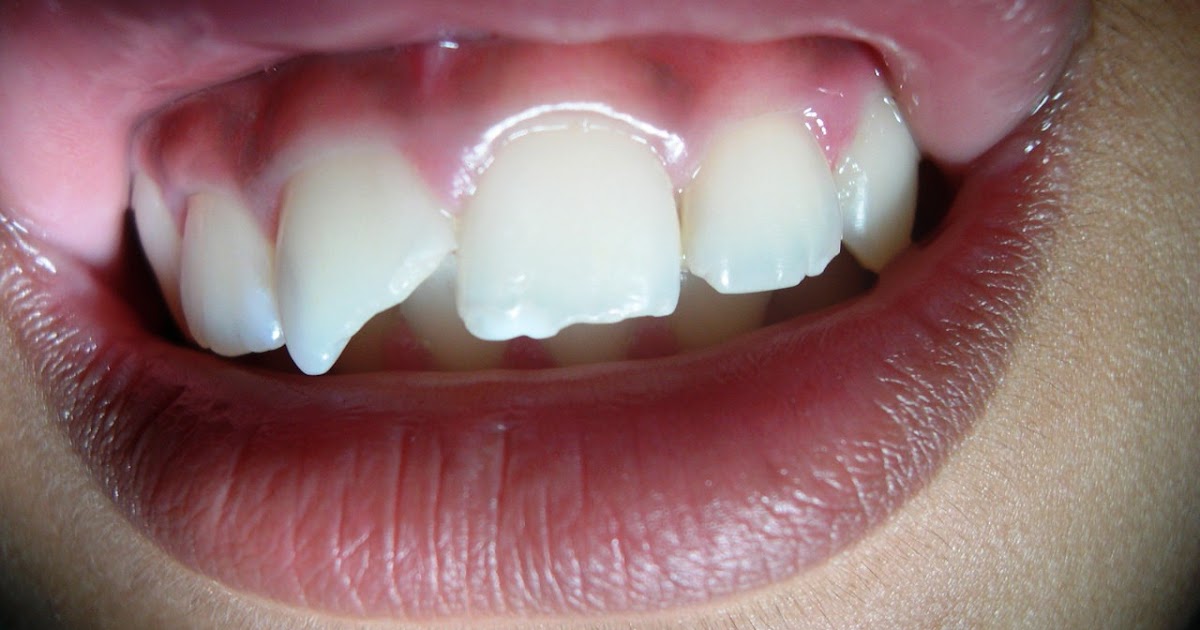 true smile dental clinic Restoration of Fractured Anterior Teeth