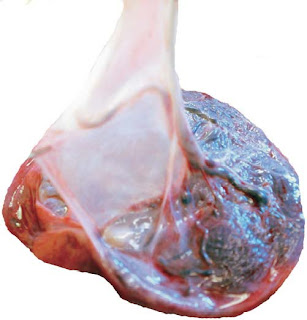 Furcate Cord Insertion