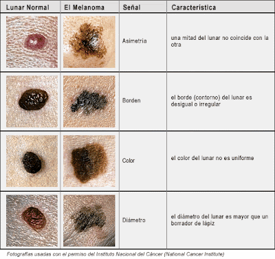 Cómo controlar los lunares para prevenir el melanoma