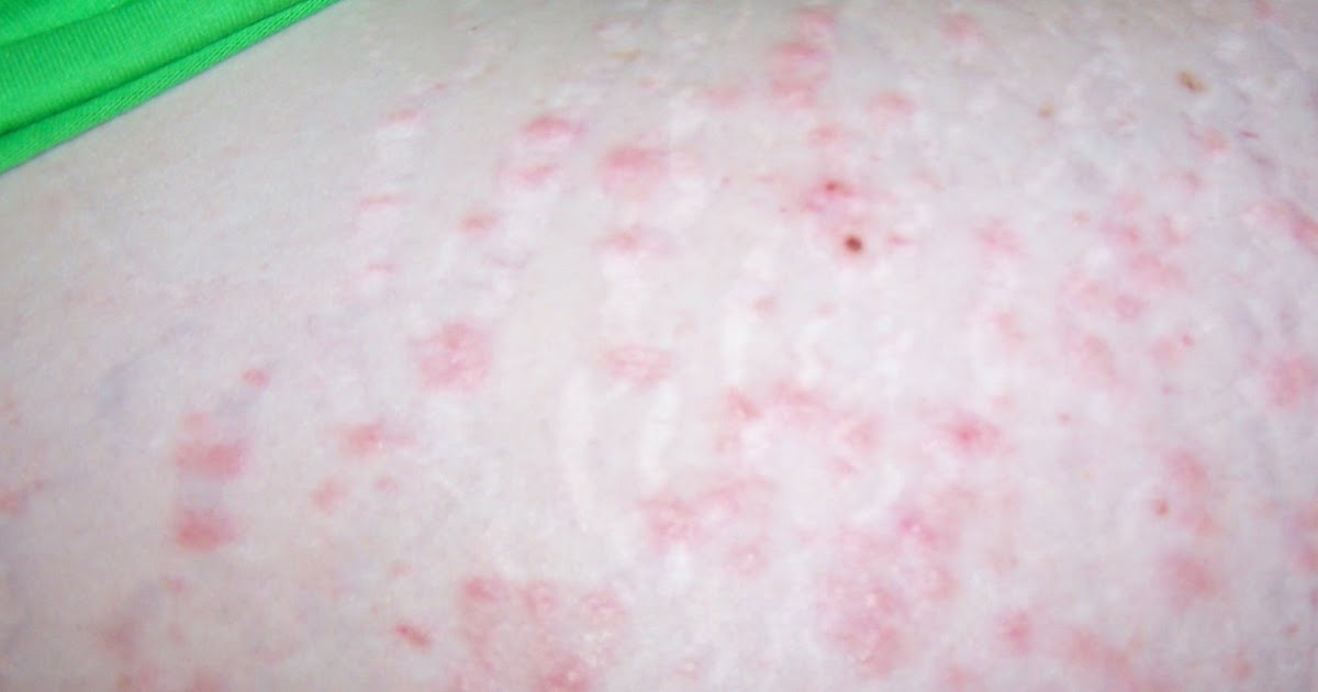 The Heath's PUPPP rash