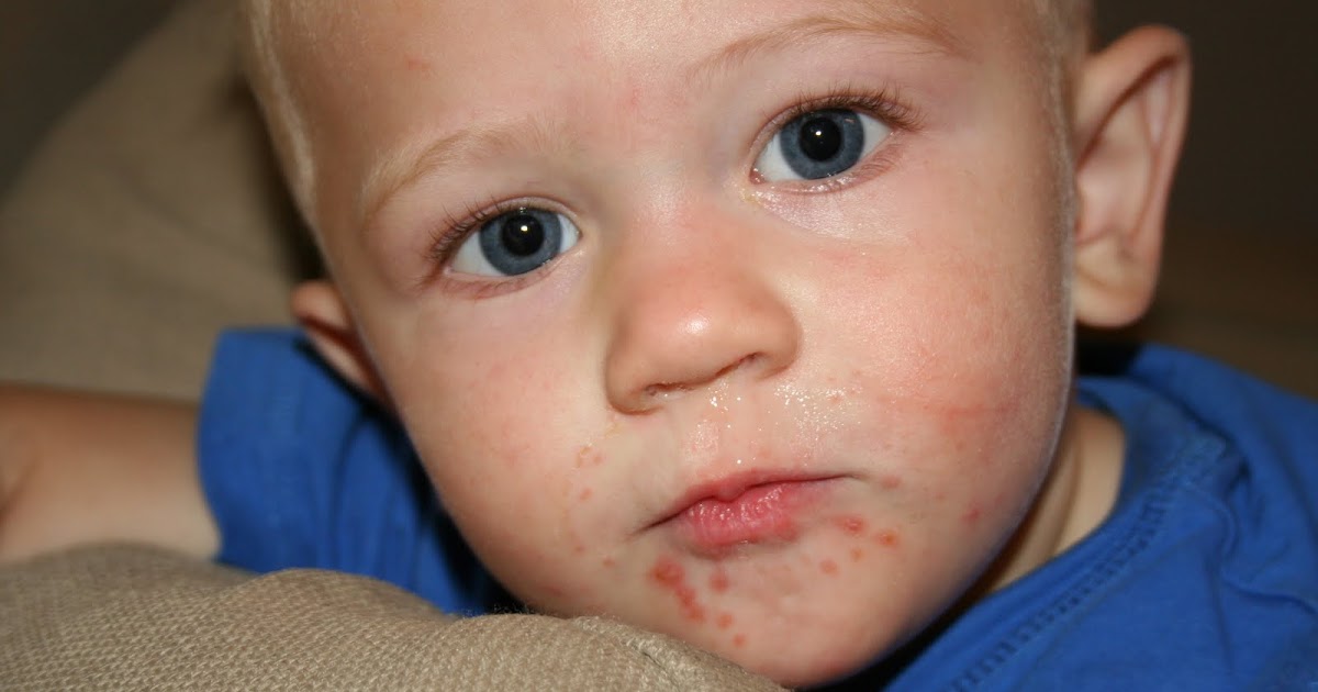 Maher thoughts hand, foot, mouth