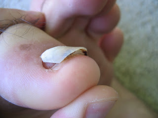 The End Of Nail Harqueb Us I Thought That Was My Bare Toe Down There Dented In From The Pressure Of Funky Toenail But It Turns Out S An Entirely New Growing